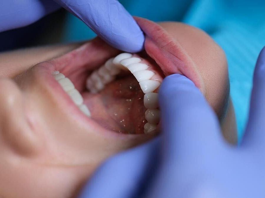 Gum Disease May Raise Stroke Risk, Even Damage the Brain